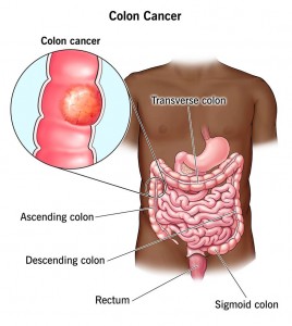 14501-colorectal-cancer