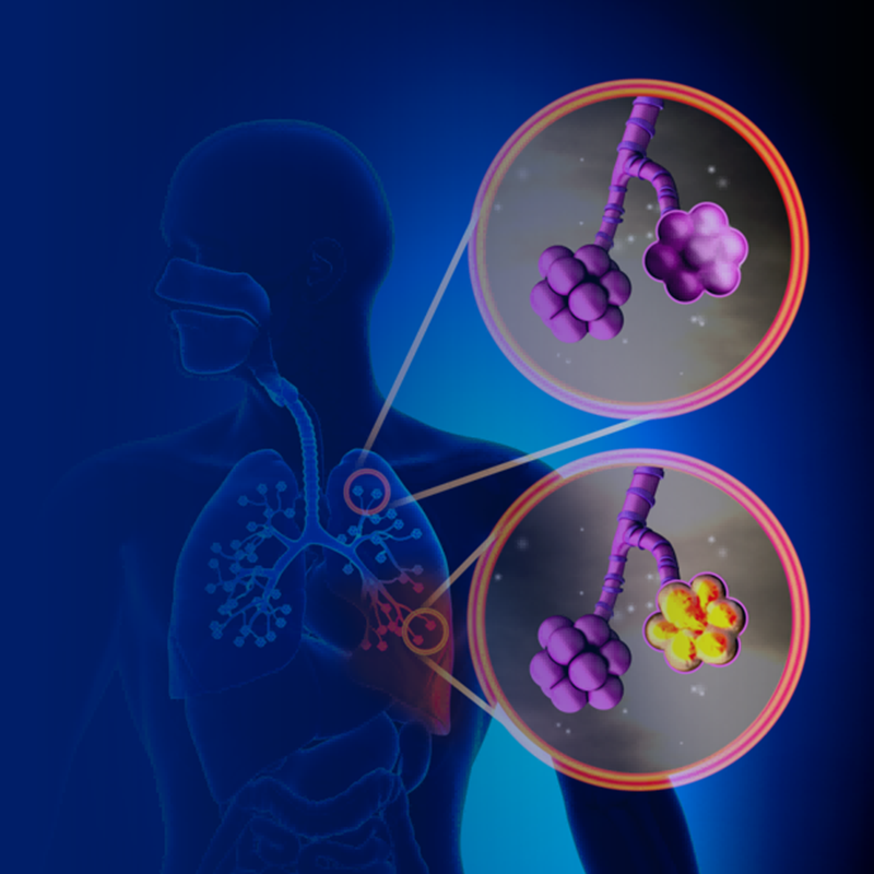 How to differentiate between influenza and mycoplasma pneumonia?