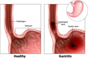 Gastric