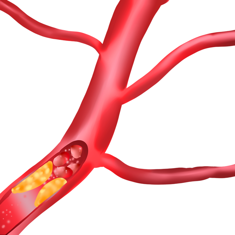 World Thrombosis Day :Troponin I Test assists Thrombosis Detection