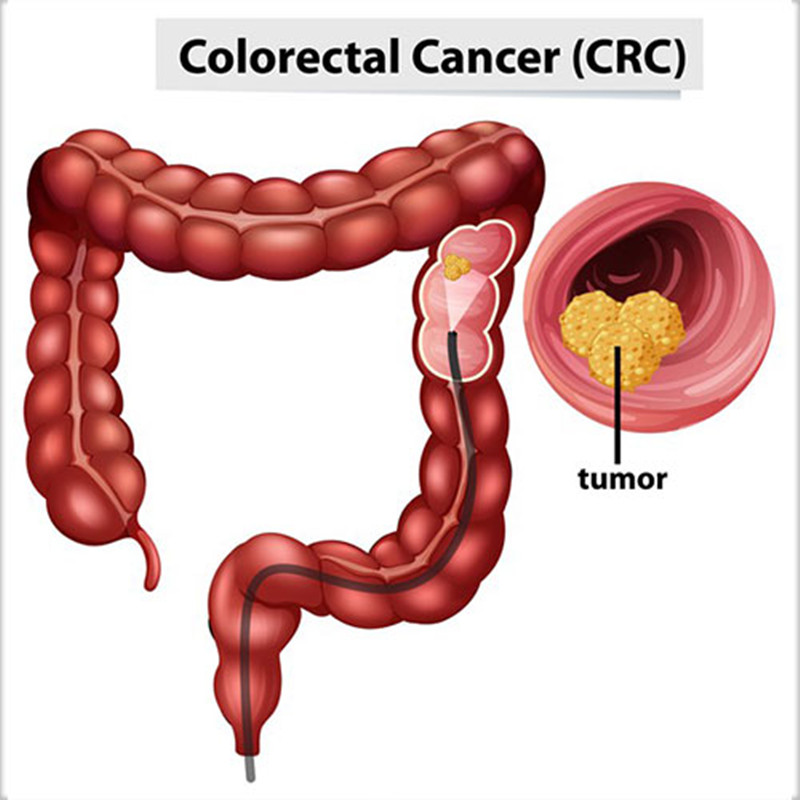 The important of early screening of  colorectal cancer