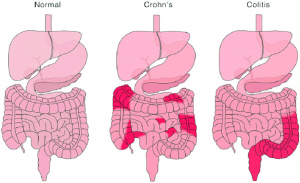 nflammatory-bowel-disease-symptom-model-7